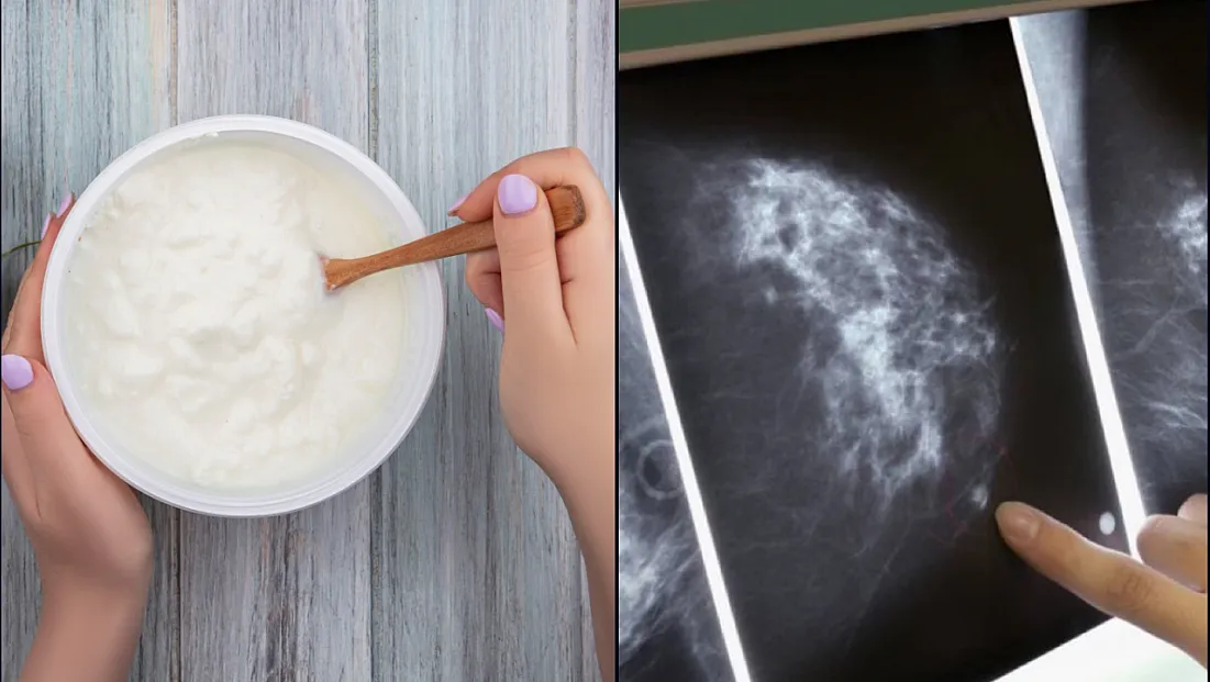 Bilim insanları meme kanseri ile bakteriyel iltihaplanma arasındaki olası ilişkiyi araştırdı