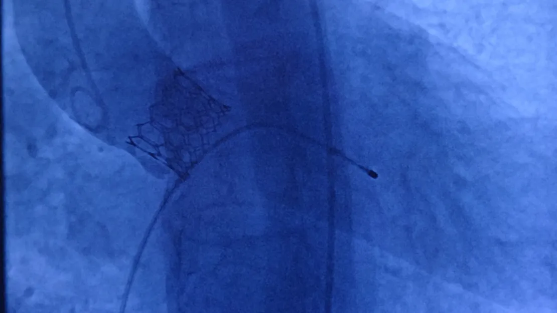 TAVI yöntemiyle kalp hastası yaşlılar sağlığına kavuşuyor