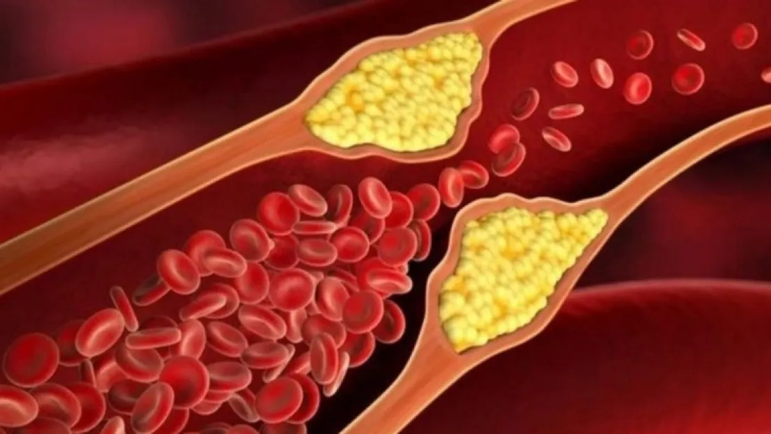 Yüksek Kolesterol Nedir? Kolesterol Hastaları Nelere Dikkat Etmeli?