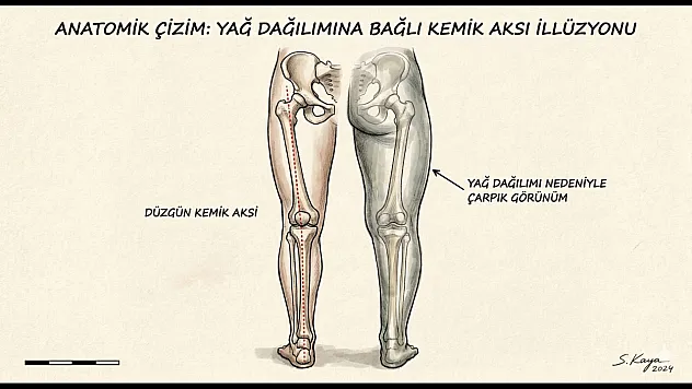 Bacak Estetiğinde Yeni Yaklaşım: Işık ve Gölge ile Kamuflaj