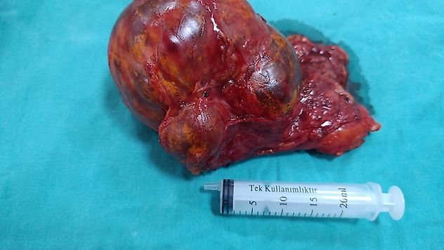 Malatya'da Riskli Ameliyat Başarıyla Tamamlandı
